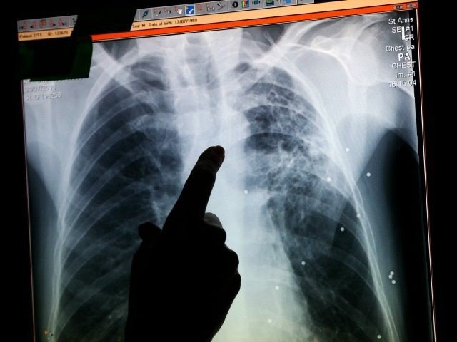 X-ray of TB-dc7b651f